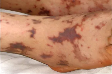 Meningococcal septicemia is a serious type of blood poisoning caused by the Neisseria meningitidis bacteria. A significant rash can develop as the infection damages blood vessels throughout the body. (Photo Credit: Nydia Gregory/Medical Images)