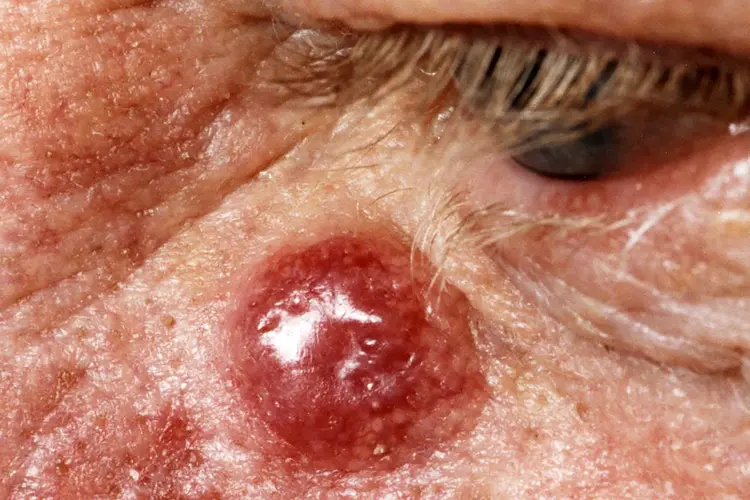 photo of  Merkel cell carcinoma