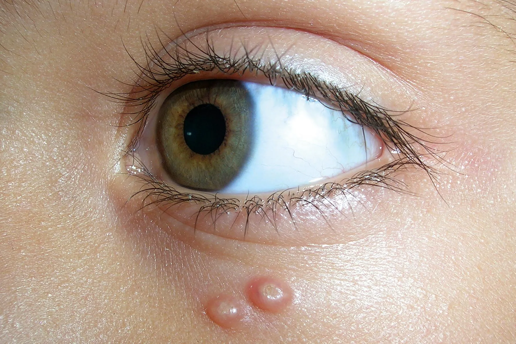 photo of molluscum montagiosum under eye