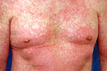 Morbilliform rashes can happen after you start a new medicine. It looks like red, measles-like spots on your skin, or it may appear darker on different skin tones. (Photo Credit: DermNet/www.Dermnetnz.org 2022)
