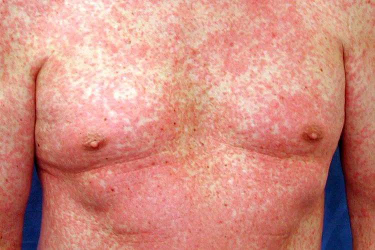 photo of Morbilliform drug eruption