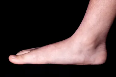 Mueller-Weiss Syndrome can collapse your foot and lead to flatfoot. Photo credit: ISM/Jean-Claude Revy, Medical Images