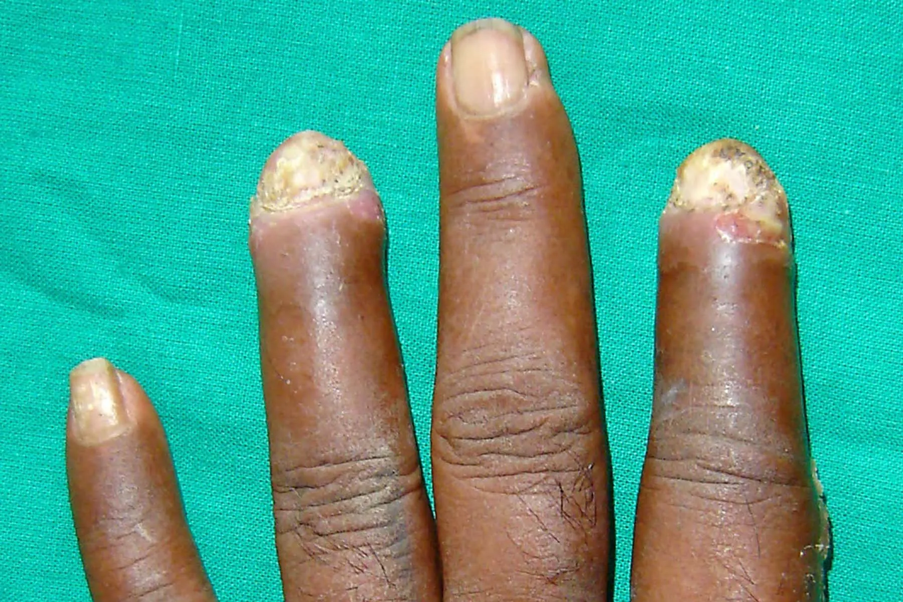 photo of nail psoriasis on dark skin