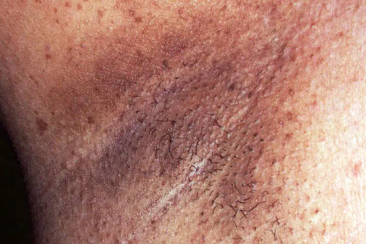 photo of neurofibromatosis crowes sign