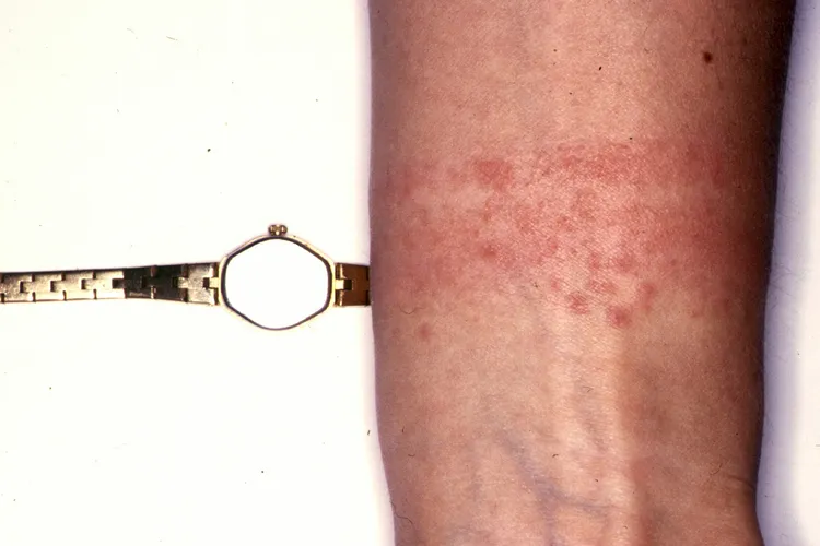 photo of Nickel contact dermatitis from watch