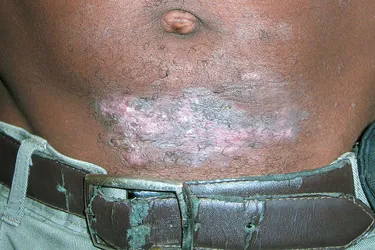 Nickel contact dermatitis. This itchy rash is a common allergic reaction to your skin coming into contact with nickel from perhaps a metal snap on blue jeans, a metal belt buckle, or nickel jewelry like earrings or watches. The lesions usually appear around the belly button but can also develop on the elbows and knees. Though general mild, they symptoms can be debilitating with prolonged exposure. Once you’ve had nickel contact dermatitis, you are susceptible to it occurring again so you should strictly try to avoid contact with nickel.