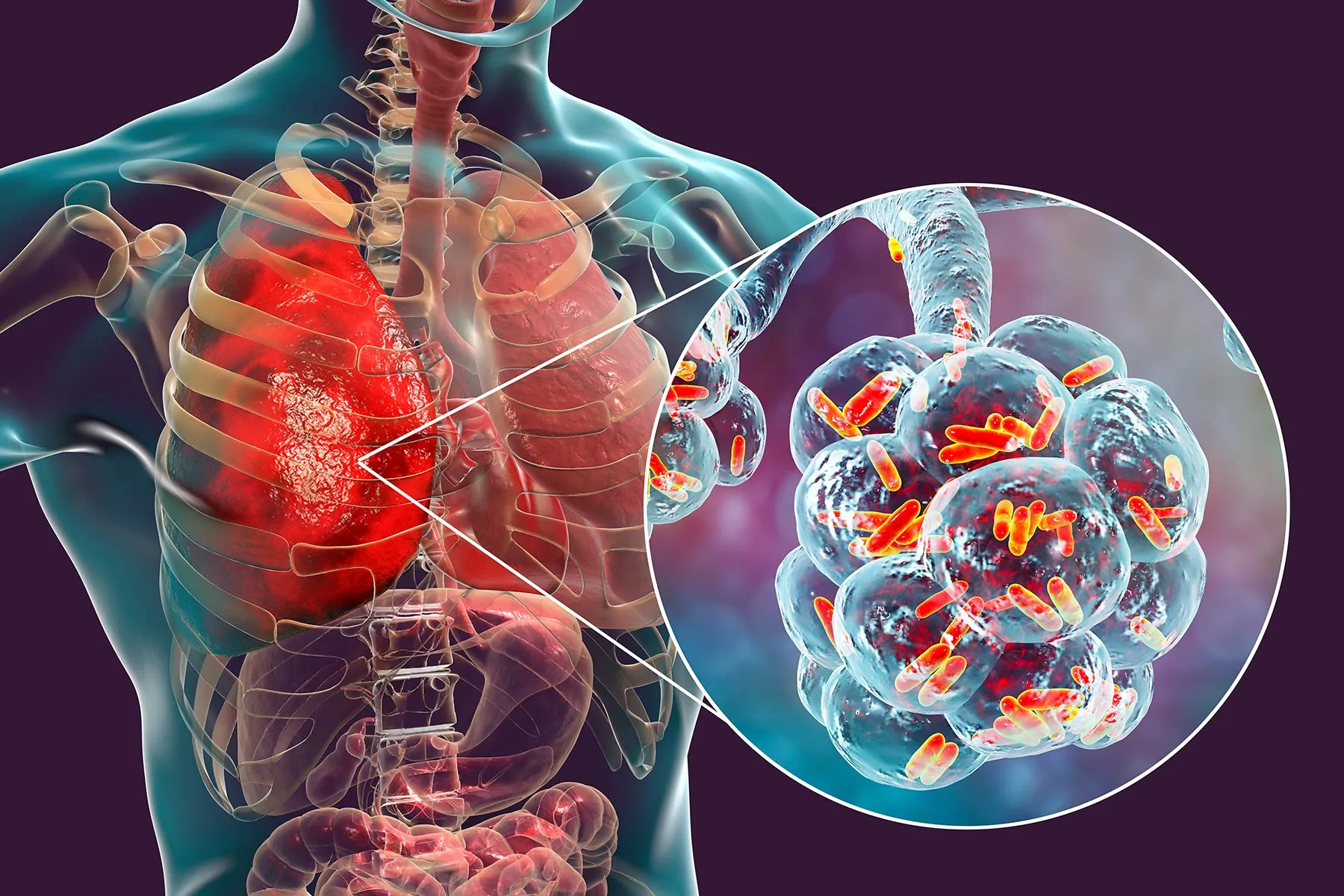 Nontuberculous Mycobacteria Explained