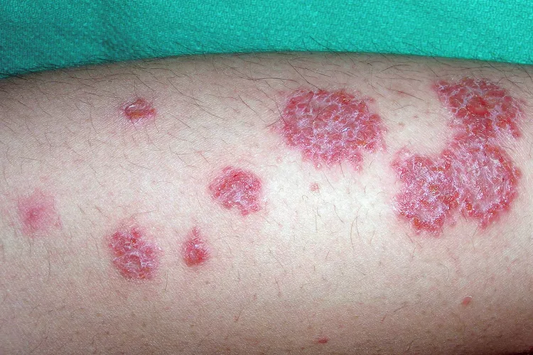 photo of nummular eczema