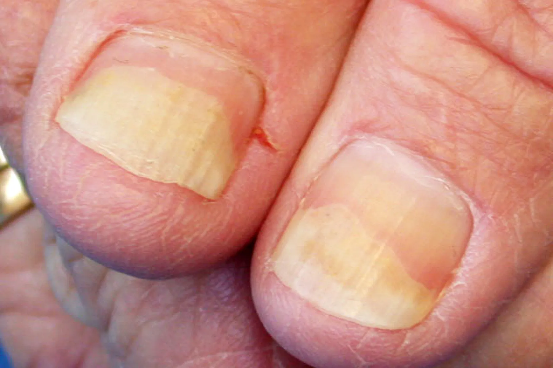 photo of onycholysis