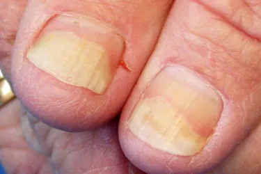 Onycholysis is when your nail separates from the nail bed. It can be caused by injury, skin disease or a fungal infection. Some people with nail psoriasis also have a fungal infection that worsens symptoms. The nails can usually be treated with topical medications applied to your nails.