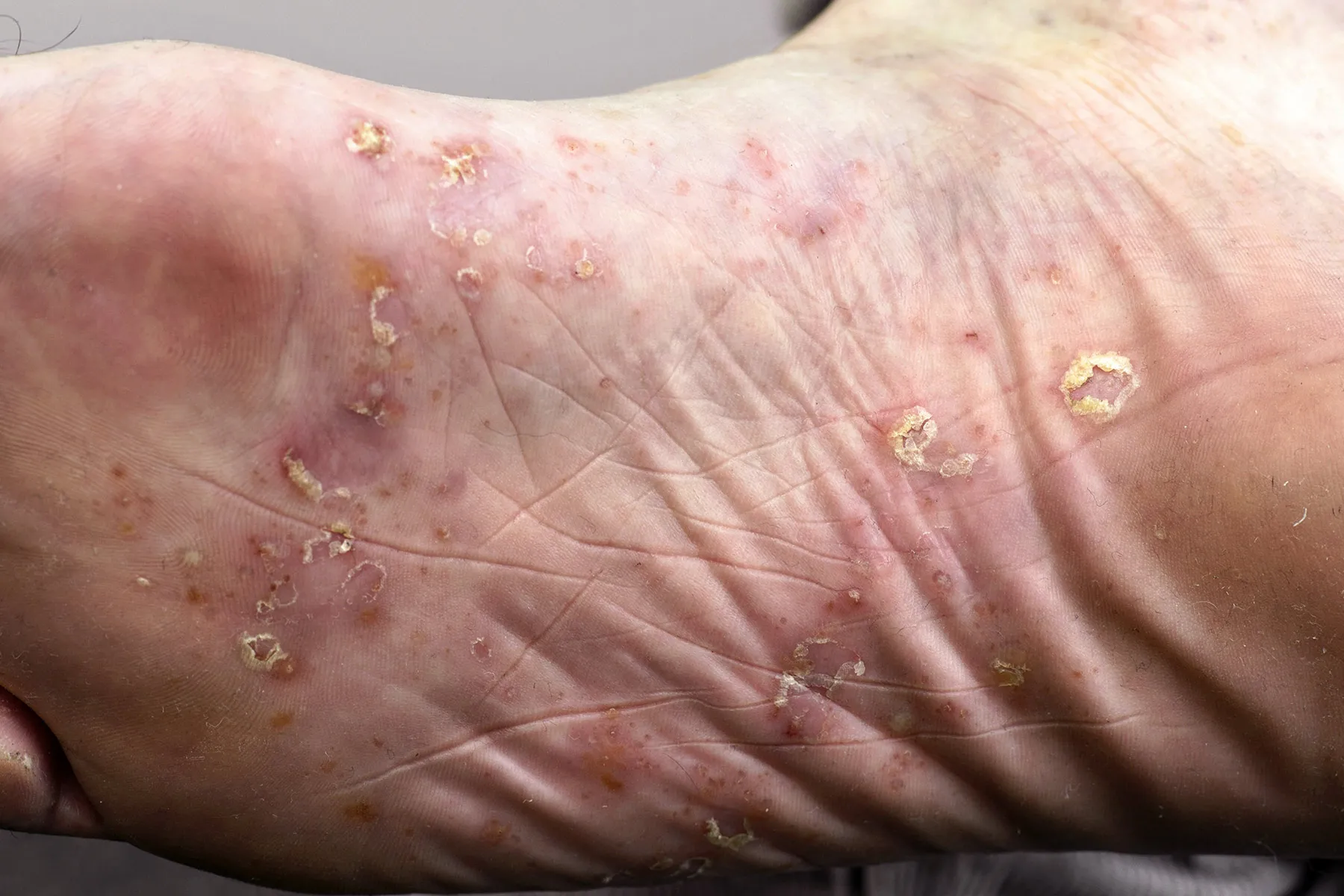 photo of palmoplantar pustulosis on feet