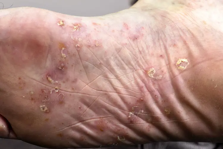 photo of palmoplantar pustulosis on feet