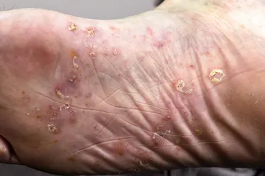 Palmoplantar Pustulosis on Feet. Palmoplantar pustulosis (PPP) is an autoimmune disorder that causes blister-like sores on the soles of your feet and the palms of your hands.