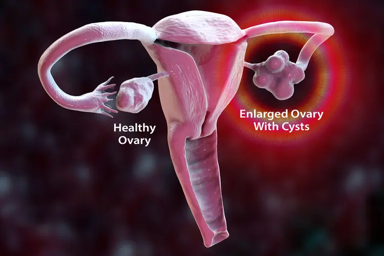 illustration of polycystic ovary syndrome