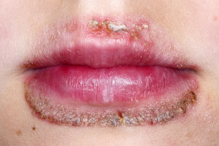 photo of perioral dermatitis around the mouth