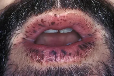  Peutz-Jeghers syndrome is a rare, inherited disorder which has a known connection to stomach cancer. It’s characterized by freckle-like spots on the lips, mouth and fingers as well as polyps in the intestines. Other common areas for the spots are the eyes, nose, hands, feet, and anus.