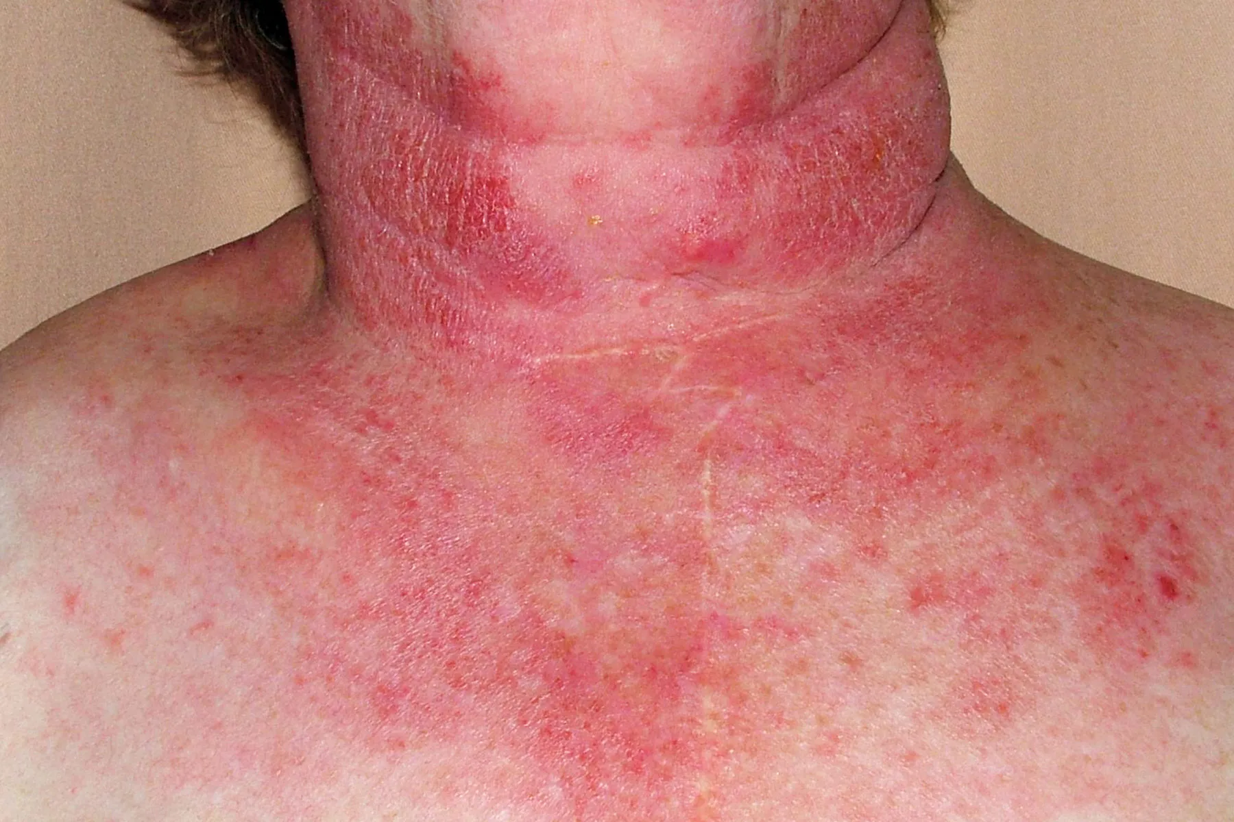 photo of phototoxic dermatitides