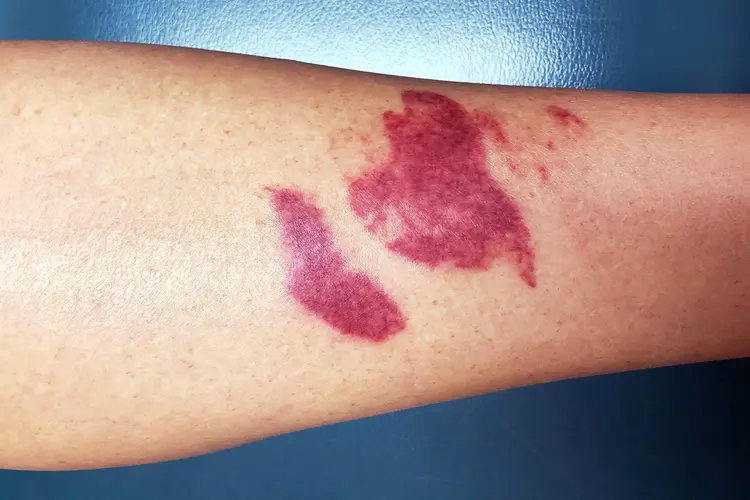 photo of phytophotodermatitis