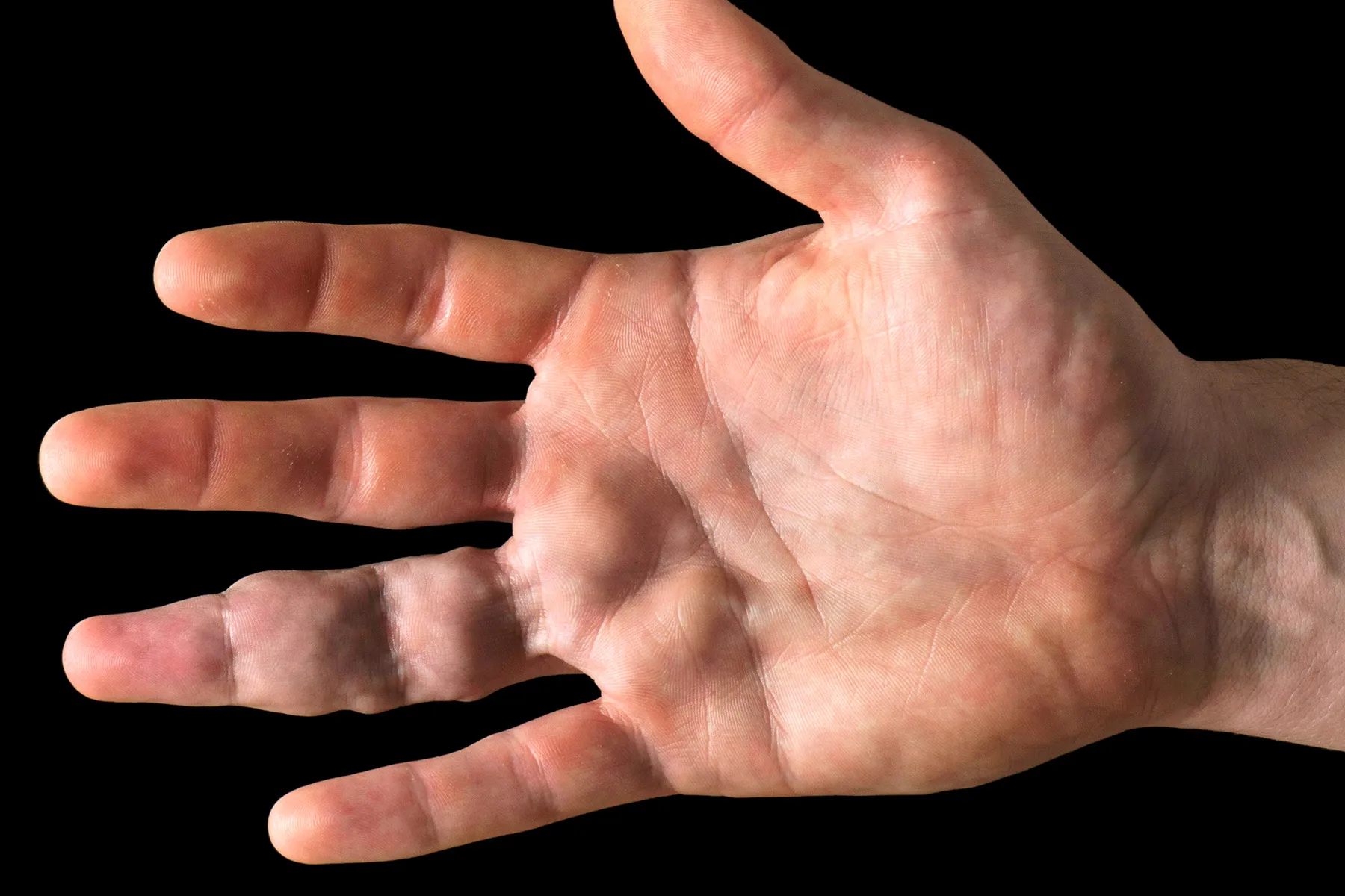 photo of vascular malformations on hand