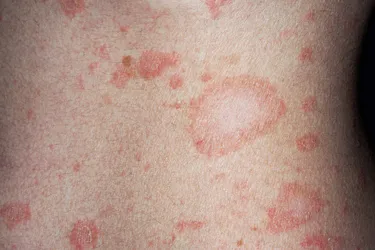 Pityriasis rosea is a rash that usually appears on the torso, upper arms, thighs, or neck. It is thought to be caused by a virus. (Photo credit: Science Photo Library / Science Source)