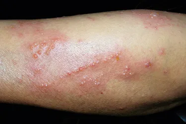 Allergic contact dermatitis. Exposure to the oily sap (urushiol) of poison ivy, poison oak, and poison sumac can result in redness and itchy blisters which can spread if scratched. The rash is an allergic reaction and can appear within hours of exposure or up to a few days after exposure.