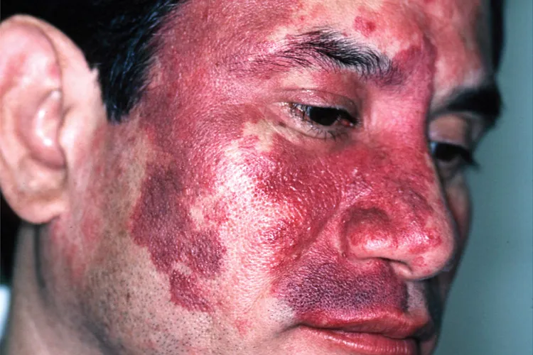 photo of port-wine stain on man's face