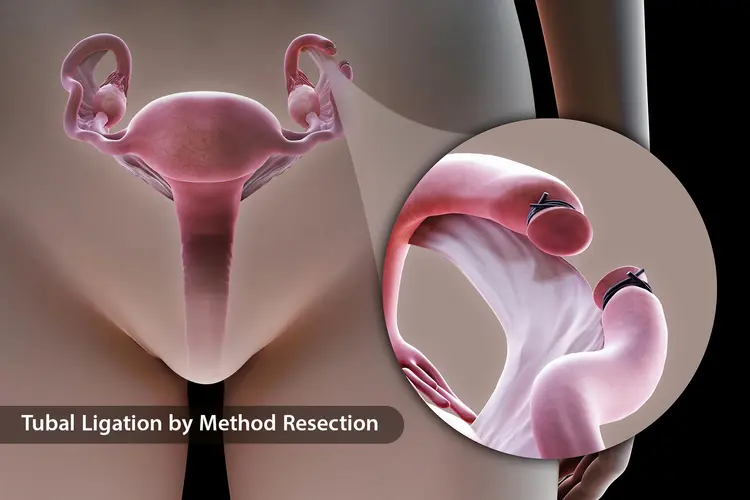 A visual of tubal ligation, a procedure that prevents pregnancy