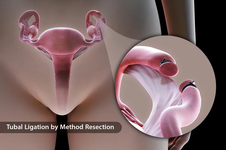 photo of tubal  ligation by method resection
