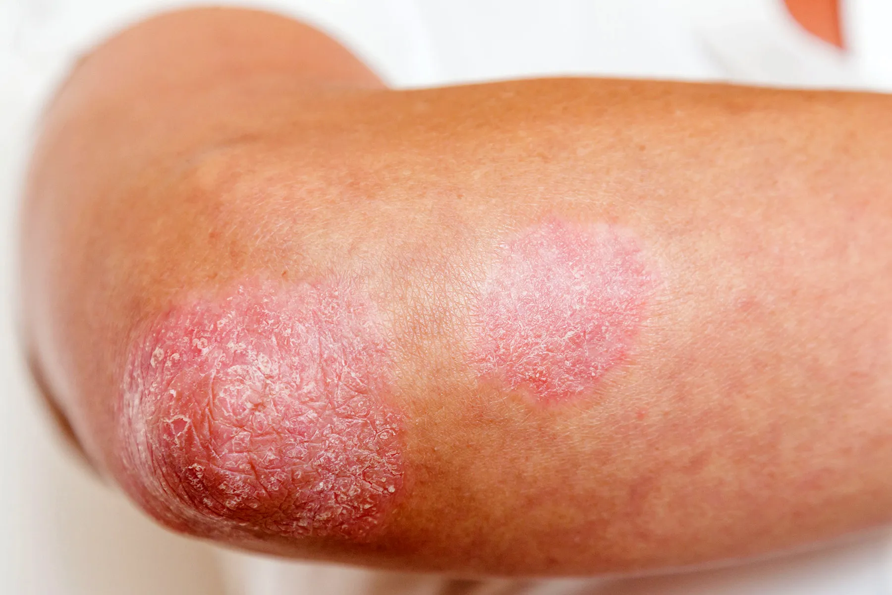 photo of Psoriasis vulgaris erythematous