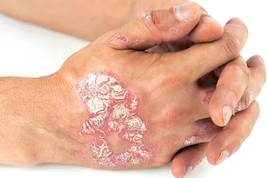 Plaque psoriasis is the most common form of psoriasis. It commonly appears as red or purple, silvery-scaled plaques. (Photo Credit: 2Ban / Getty Images)