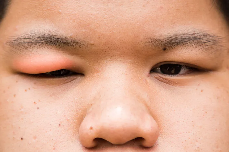 photo of man with swollen eyelid