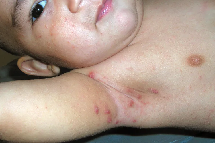 photo of scabies on baby's armpit