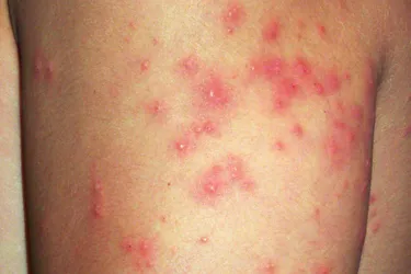 Seabather’s itch, also called seabather’s eruption, is a burning, itching rash that can occur when a swimmer gets stung by tiny thimble jellyfish, often mistakenly referred to as sea lice. The larvae get trapped in the fabric of the bathing suit and sting the swimmer. The problem is common between May and August along the southeast coast of the United States, the Gulf of Mexico and the Caribbean.