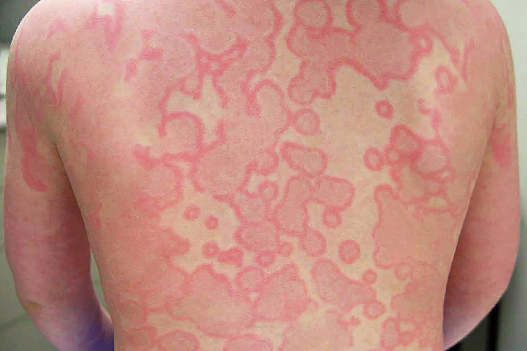 photo of serum sickness on man's back