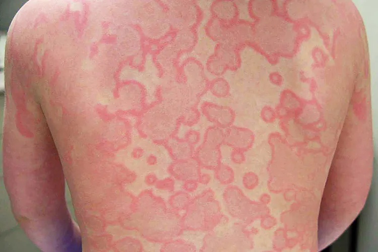 photo of serum sickness on man's back
