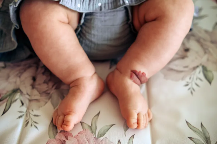 photo of birthmark on baby's foot
