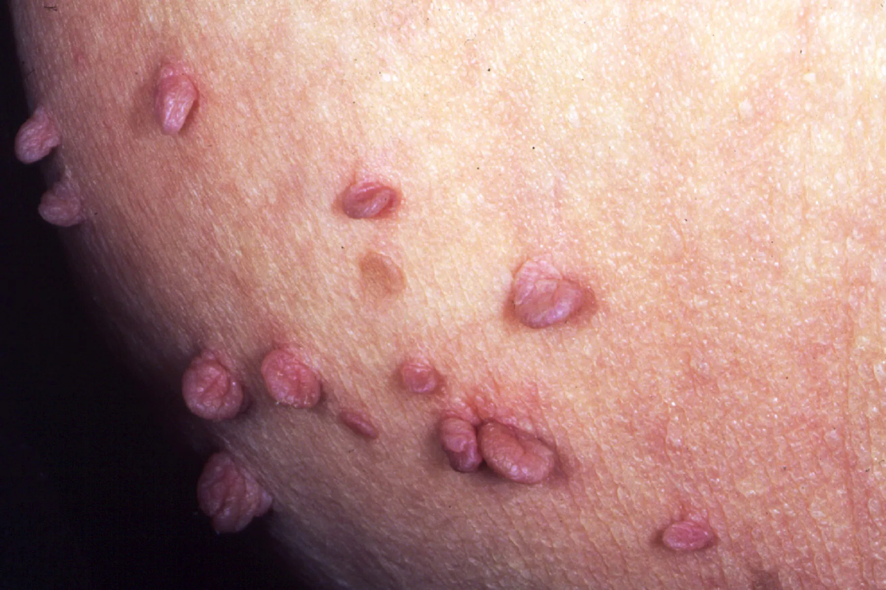 photo of skin tags