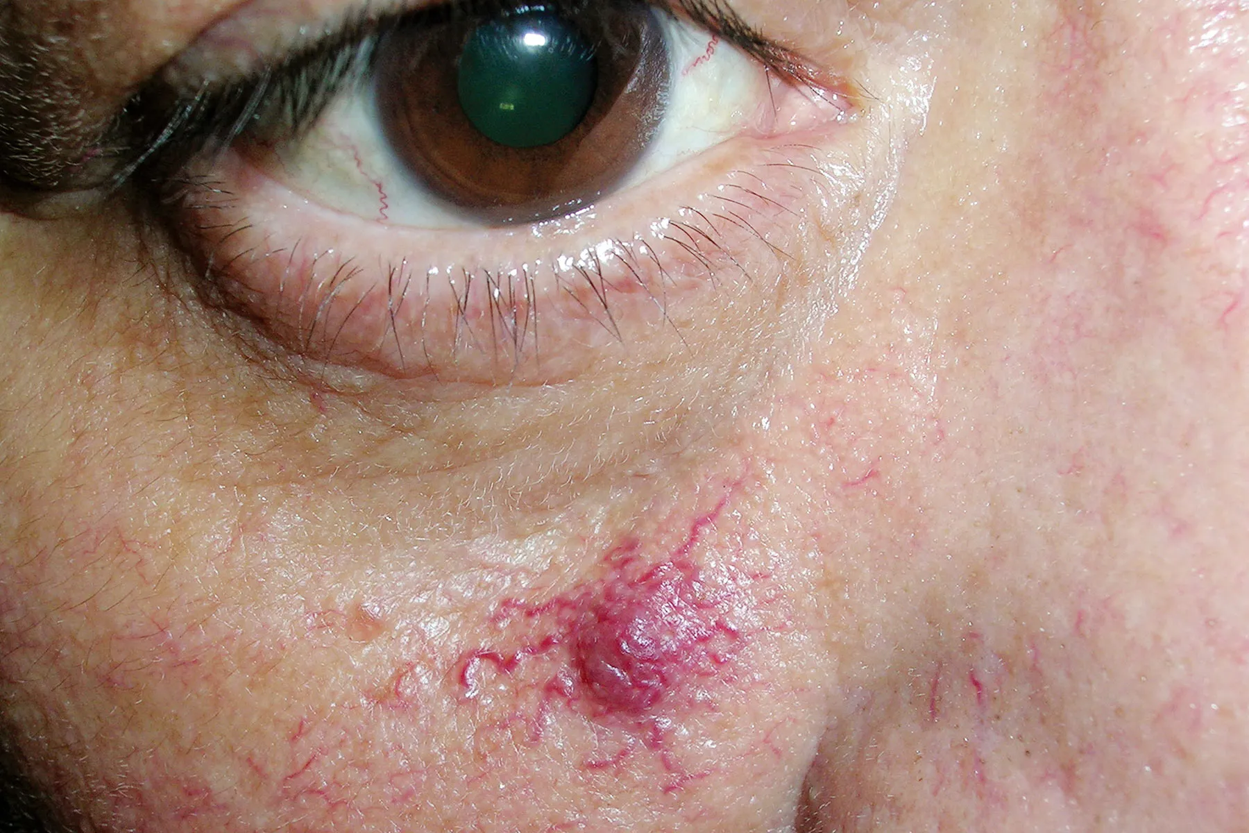 photo of  spider angioma on cheek