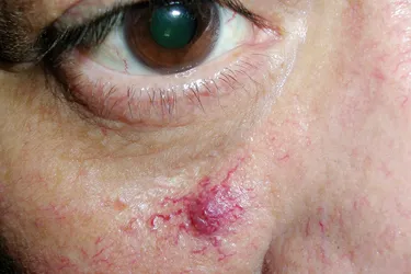 Spider angioma or spider nervus is a common development of small blood vessels. Its name comes from its appearance which generally has a central red blood vessel with small capillaries radiating from it so that it resembles a spider.  The vascular cluster is benign and poses no harm. (Photo Credit: Richard Usatine, MD)