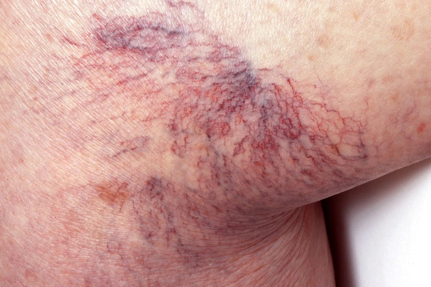 photo of spider veins