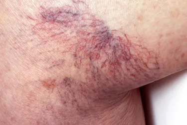 Spider veins twist and turn and look like a spider’s web or tree branch. They are usually red, purple, or blue and easily visible through the skin. They are most often found on the legs and face. (Photo Credit: Science Photo Library / Science Source)