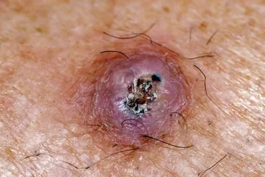 Squamous cell carcinoma in situ: Also called Bowen's disease, squamous cell carcinoma in situ is a pre-invasive squamous cell skin cancer. This means the growth is confined to the outer layer of skin. It should be removed before it spreads and develops into a life-threatening form of skin cancer. SCC is caused by exposure to ultraviolet light. (Photo Credit: Peter Skinner / Science Source)