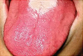 strawberry tongue