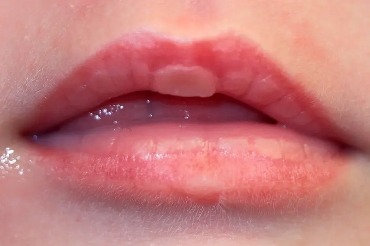 photo of Sucking blister