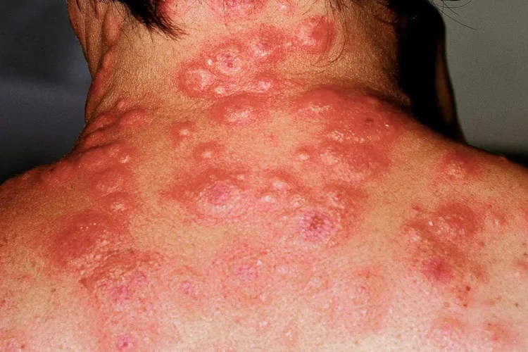 photo of sweets syndrome on neck and back