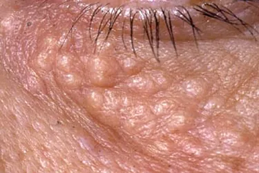 Syringomas are small bumps that appear when cells in your sweat glands grow too much. They are harmless. In darker skin tones they may appear pale or yellowish. (Photo Credit: ?DermNet NZ / www.dermnetnz.org 2022)