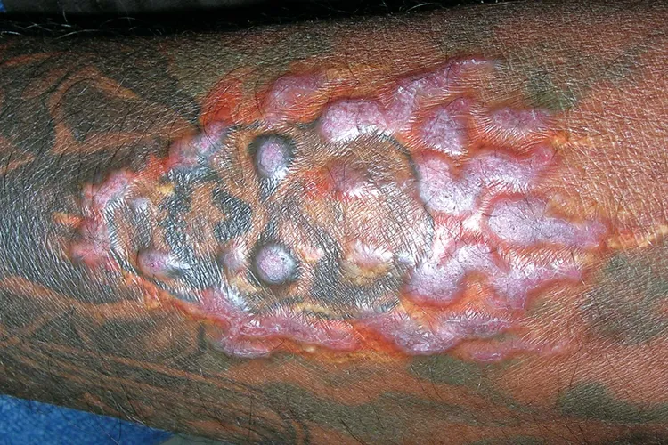 photo of tattoo allergic reaction on man's arm