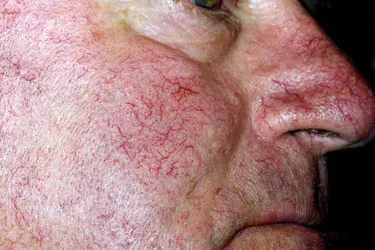 Telangiectasias are clusters of small, widened blood vessels which develop near the surface of the skin of mucous membranes. They are commonly known as spider veins. (Photo Credit: DermNet NZ) 