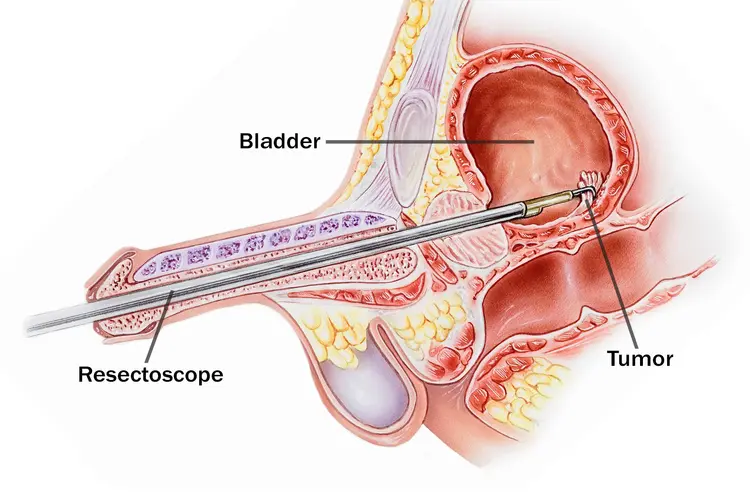 photo of resection of bladder tumor (TURBT) 