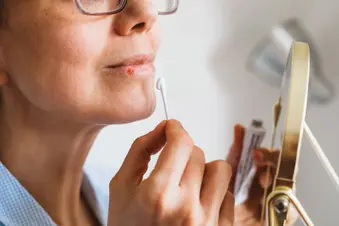 photo of woman applying ointment to cold sore